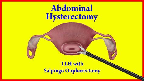 <strong>Total hysterectomy</strong> for benign uterine lesions is the most frequent gynaecological surgical operation not connected with pregnancy ( Dicker et al. . Total laparoscopic hysterectomy bilateral salpingectomy cystoscopy